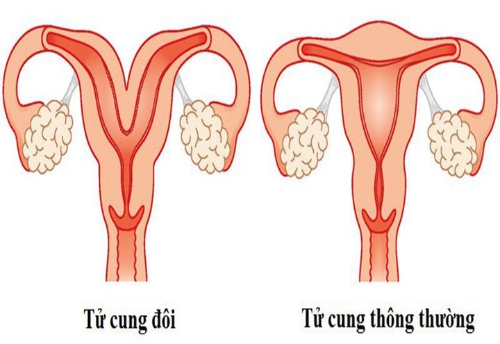 Sản phụ 24 tuổi có hai tử cung